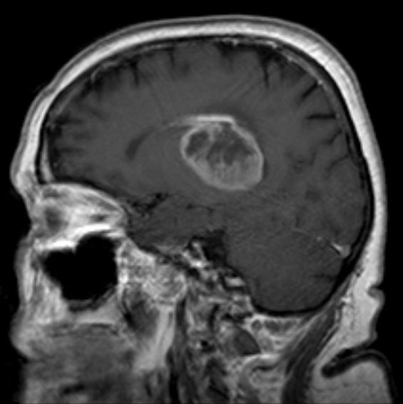 Contrast MRI of a glioblastoma showing an enhancing tumor